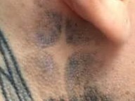 Laser Tattoo Removal After
