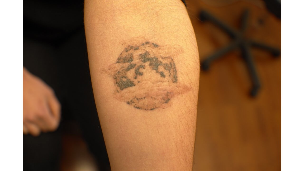 Laser Tattoo Removal After
