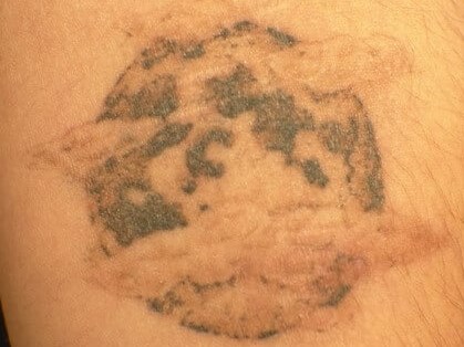 Laser Tattoo Removal After