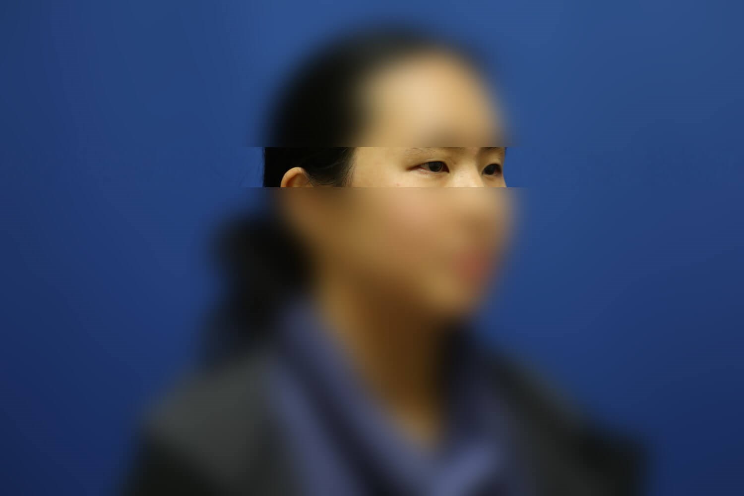 Asian Eyelid Before