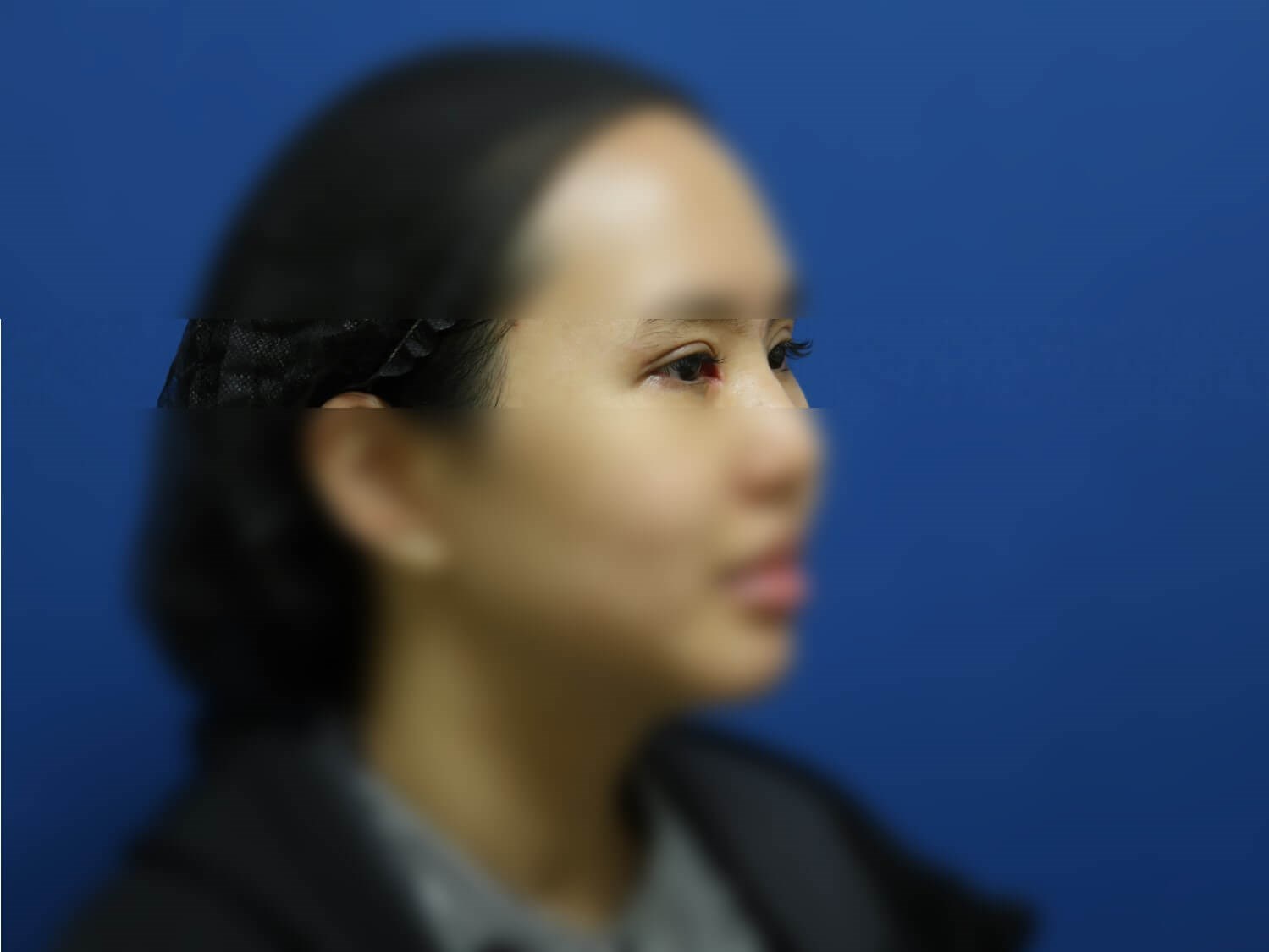 Asian Eyelid After