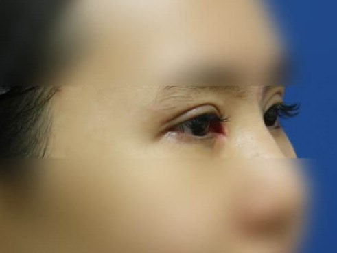 Asian Eyelid After