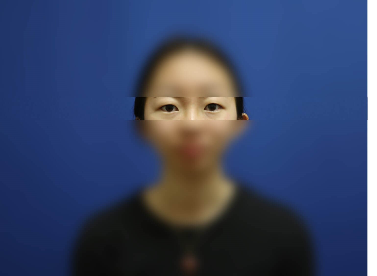 Asian Eyelid Before
