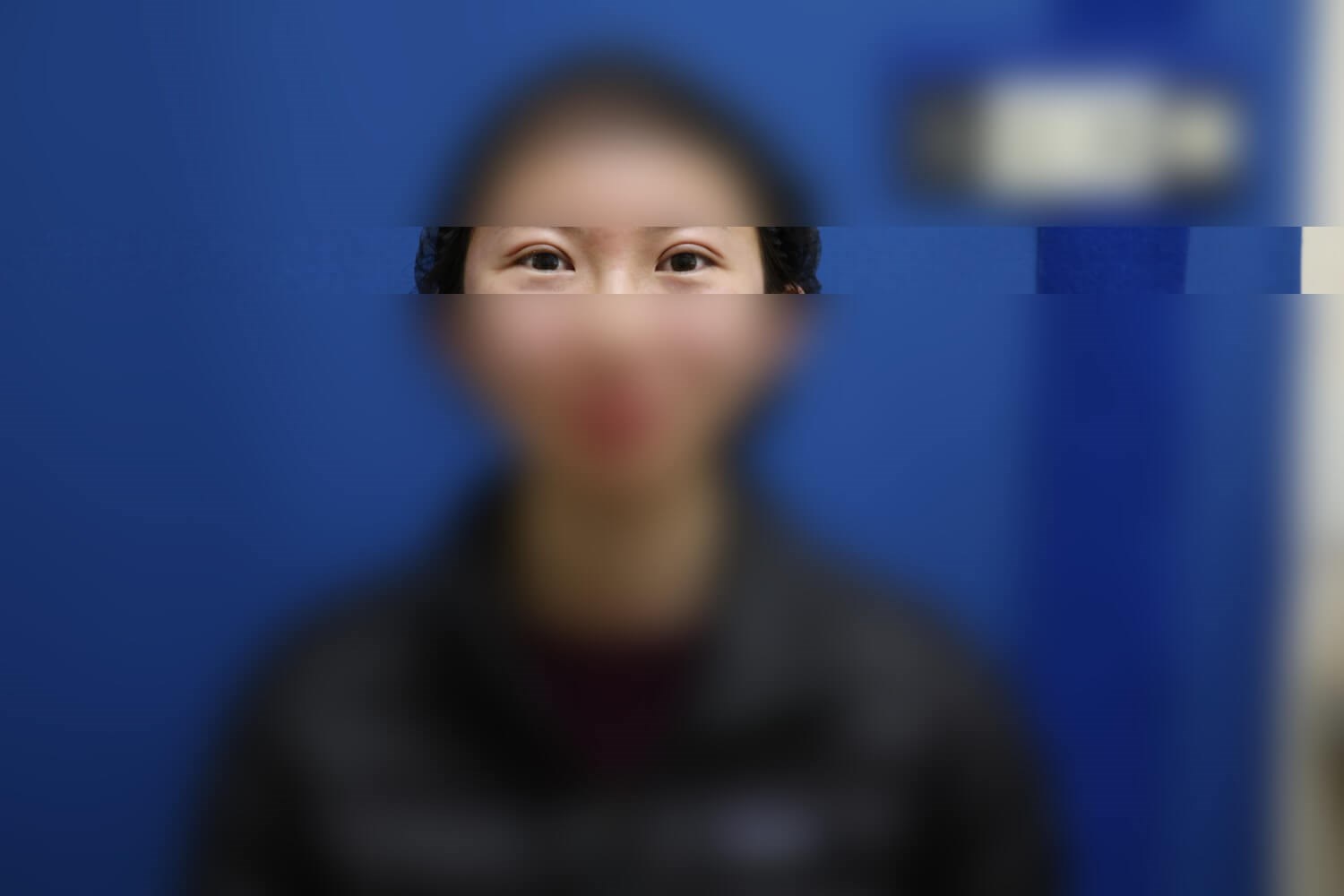 Asian Eyelid After