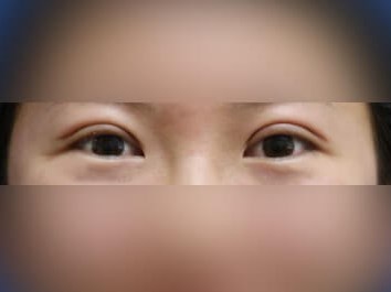 Asian Eyelid After