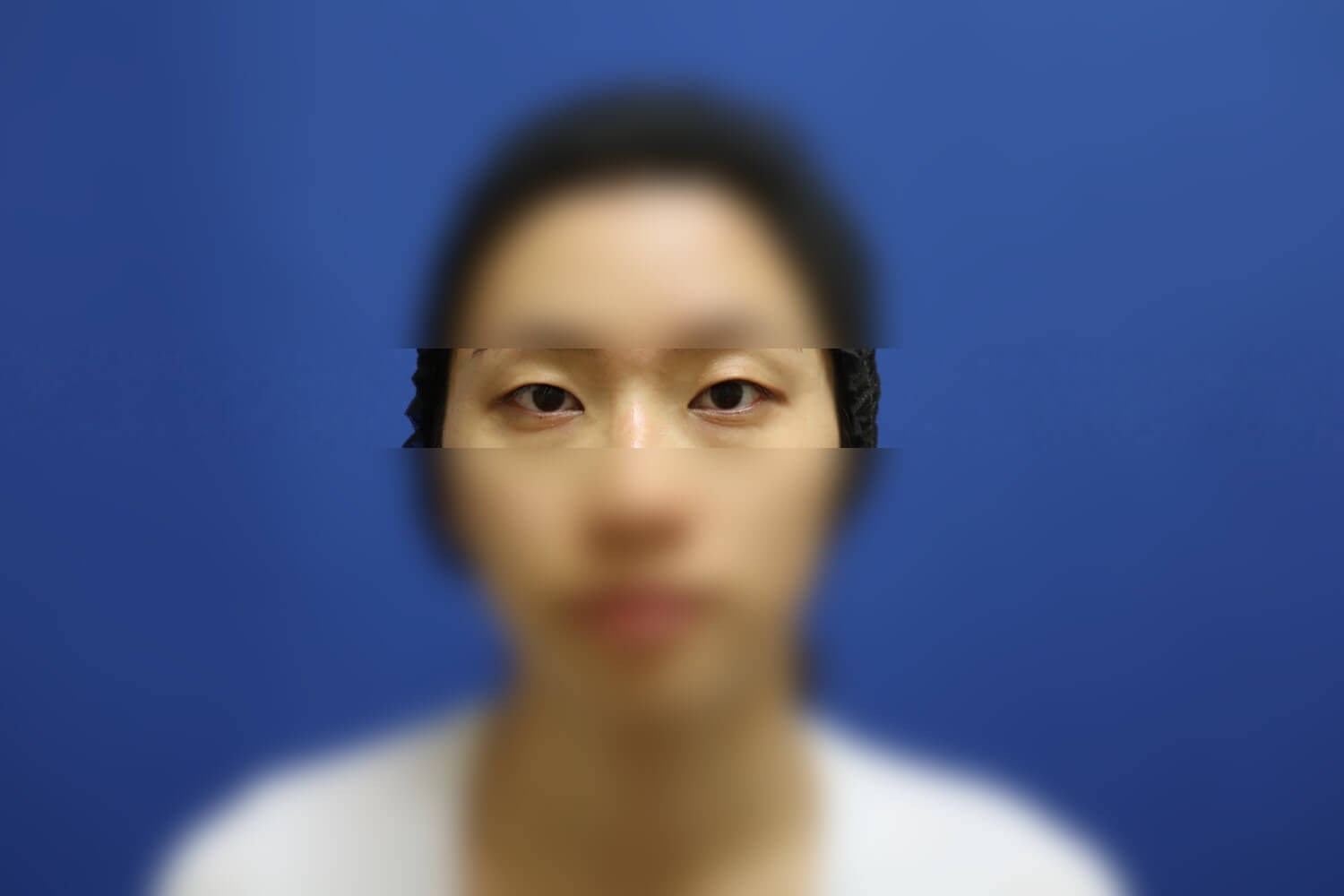 Asian Eyelid Before