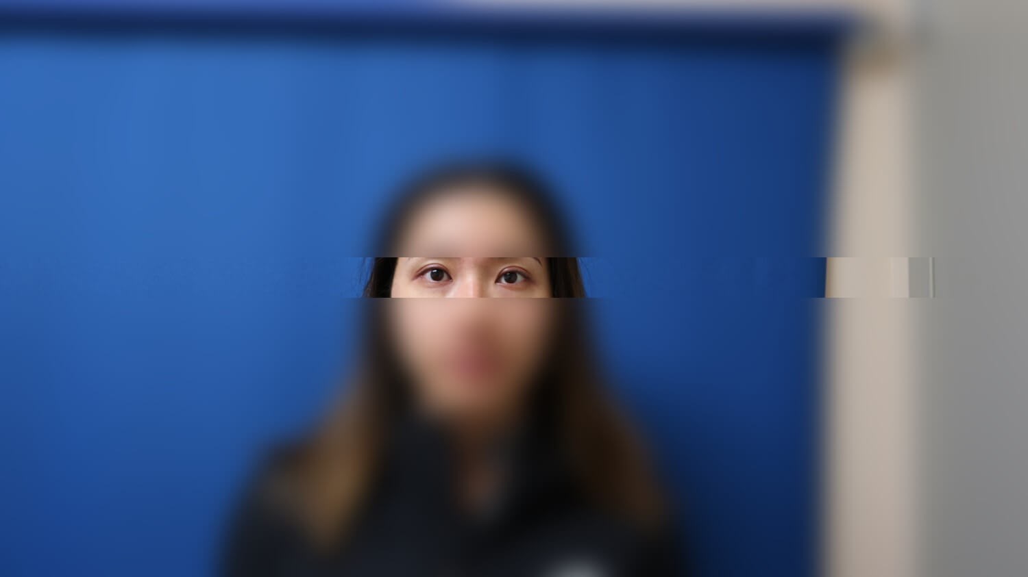 Asian Eyelid After