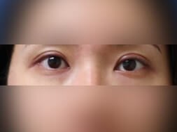 Asian Eyelid After