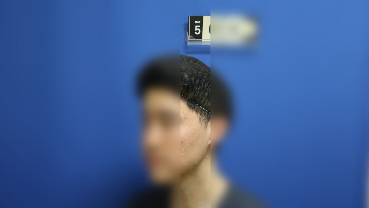 Infini Radio Frequency Laser After