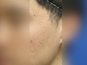 Infini Radio Frequency Laser After
