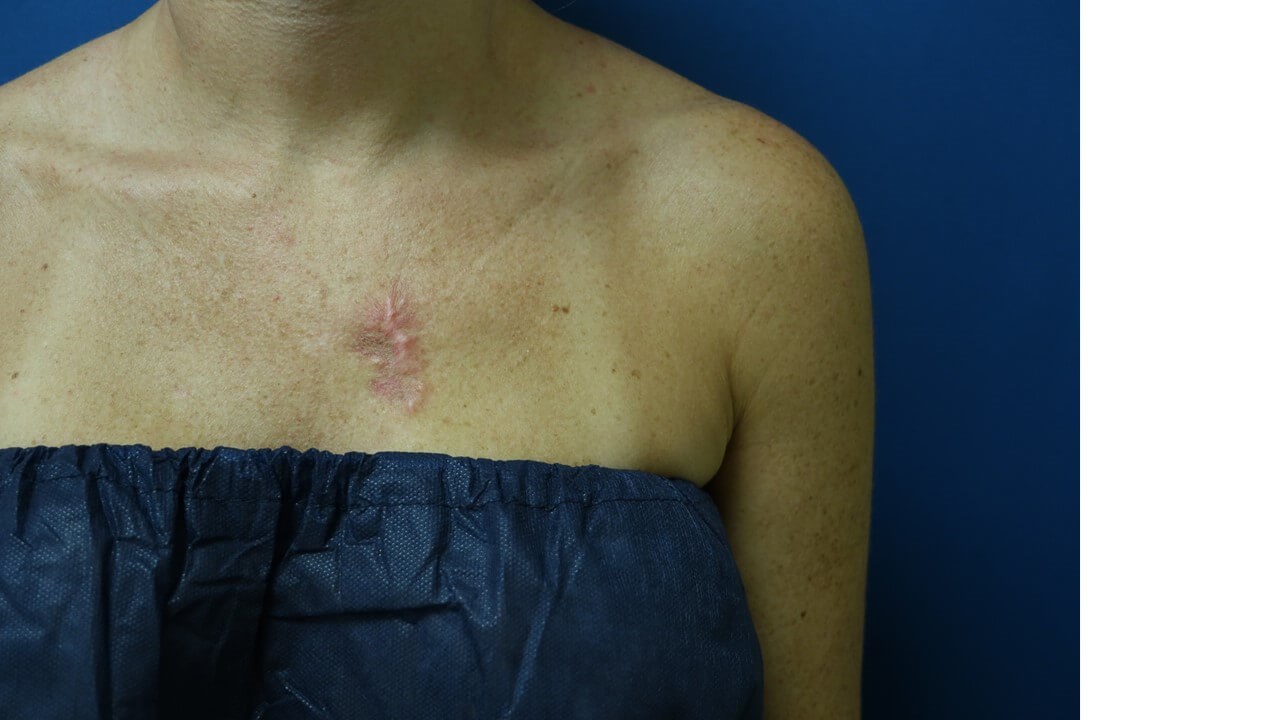 Infini Radio Frequency Laser Before