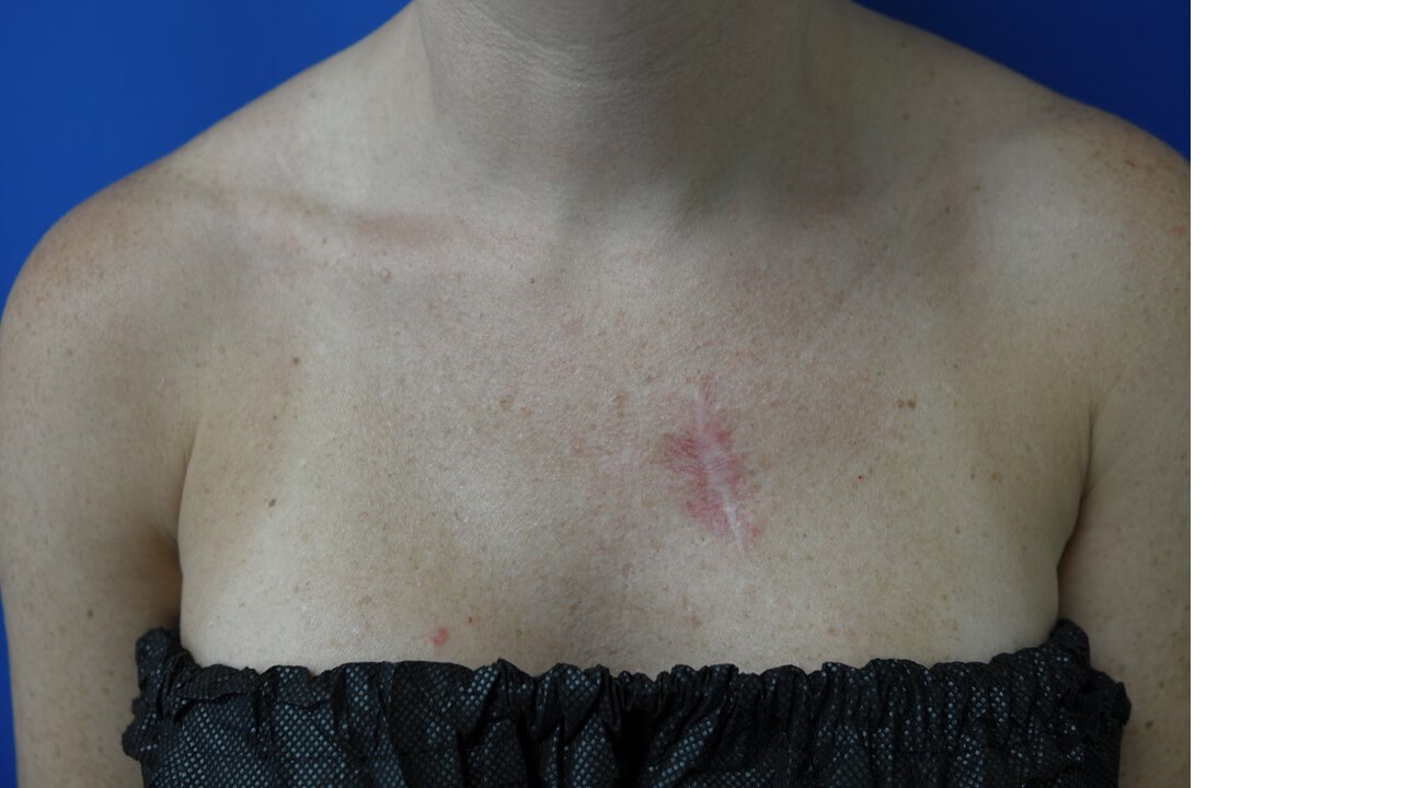 Infini Radio Frequency Laser After