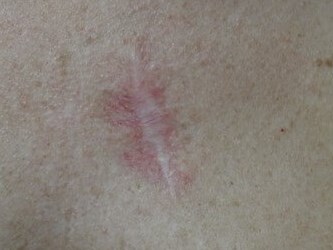 Infini Radio Frequency Laser After