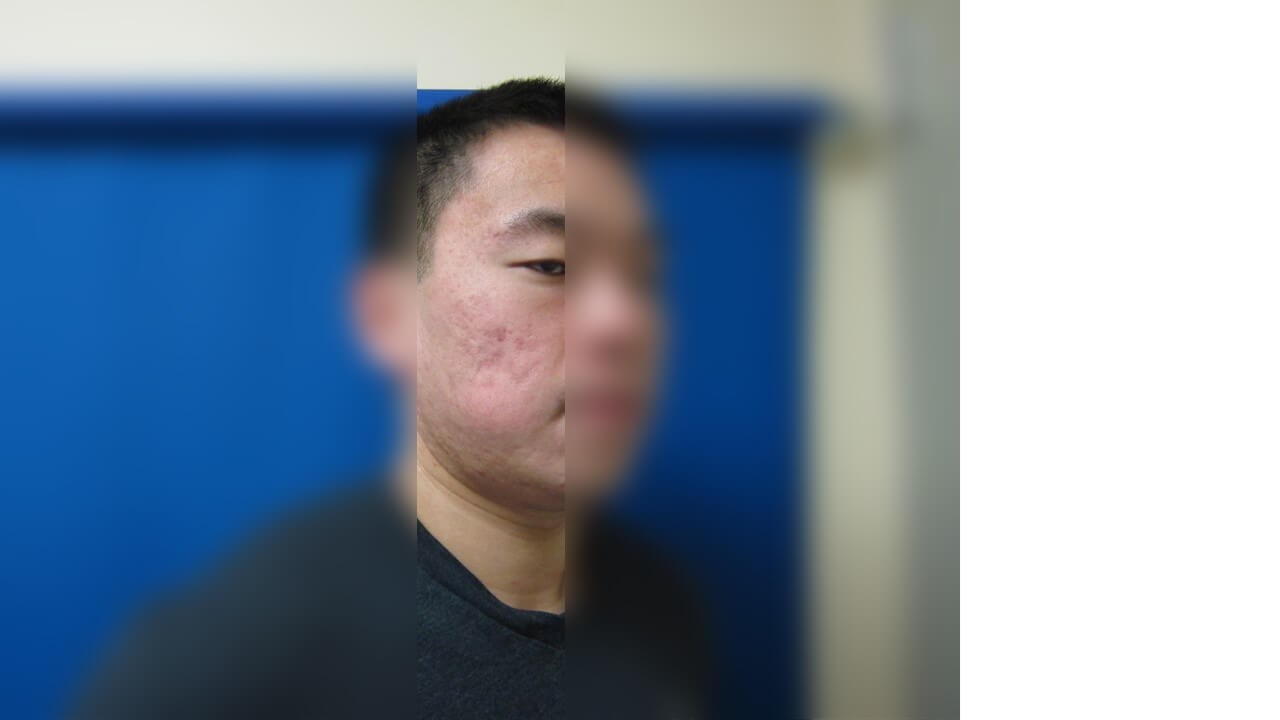 Infini Radio Frequency Laser Before