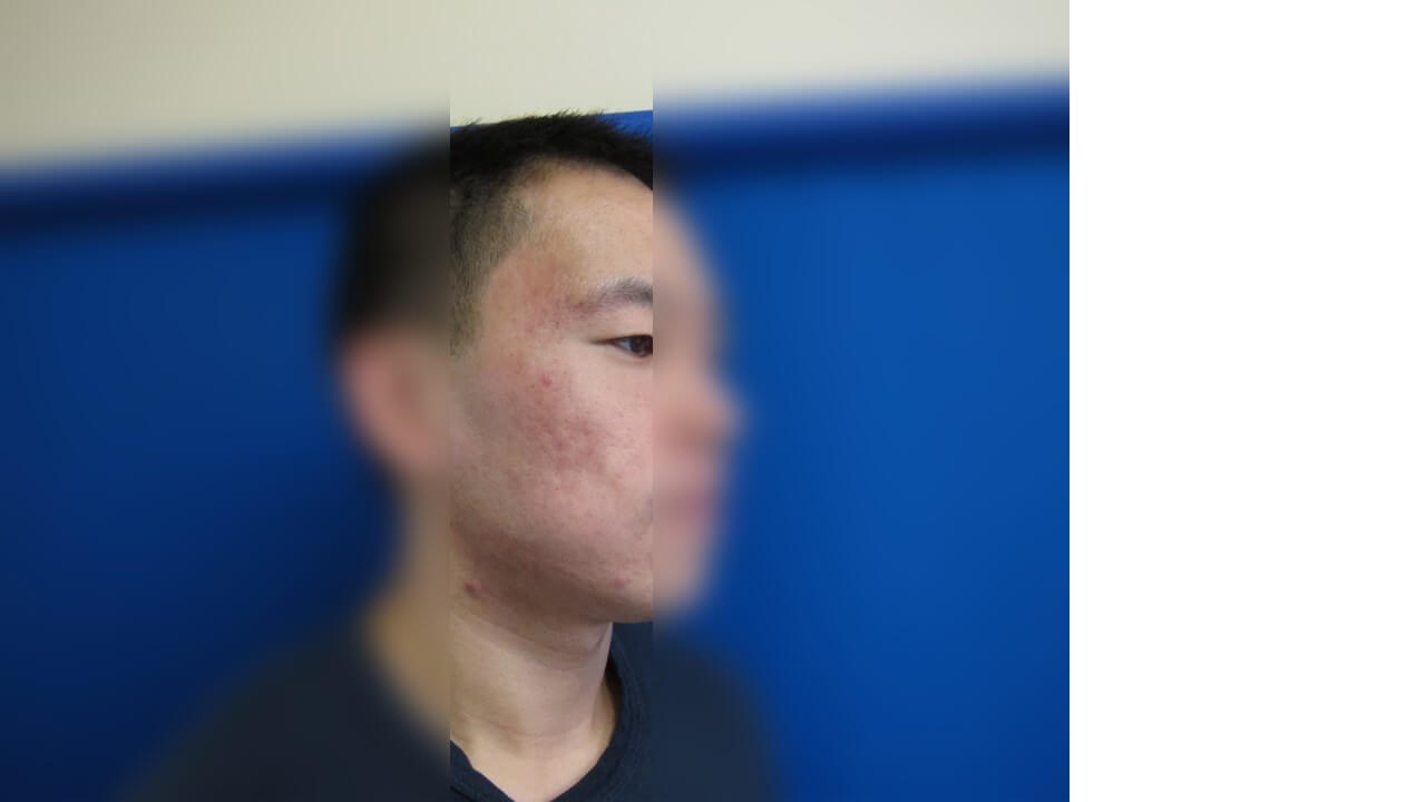 Infini Radio Frequency Laser After