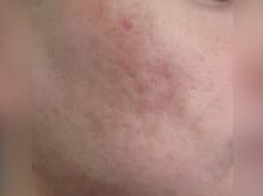 Infini Radio Frequency Laser After
