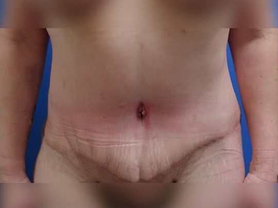 Tummy Tuck After