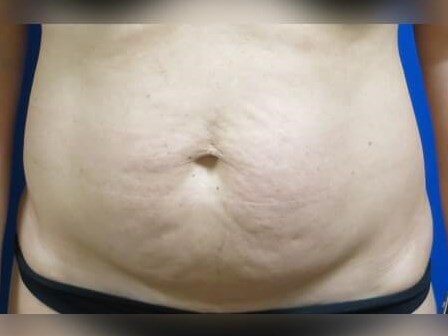 Tummy Tuck Before