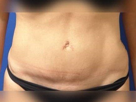 Tummy Tuck After