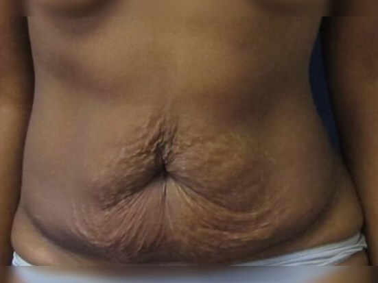 Tummy Tuck Before