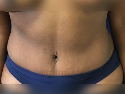 Tummy Tuck After