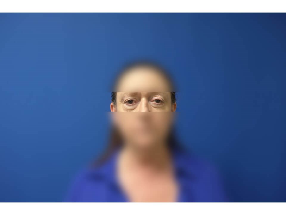 Upper Eyelid Surgery Before