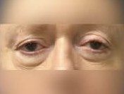 Lower Eyelid Surgery Before