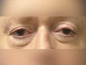 Upper Eyelid Surgery Before