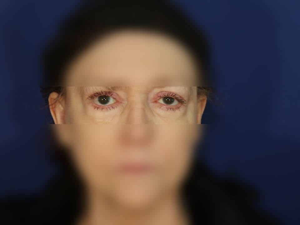 Upper Eyelid Surgery After
