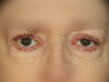 Upper Eyelid Surgery After