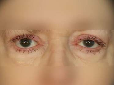 Lower Eyelid Surgery After
