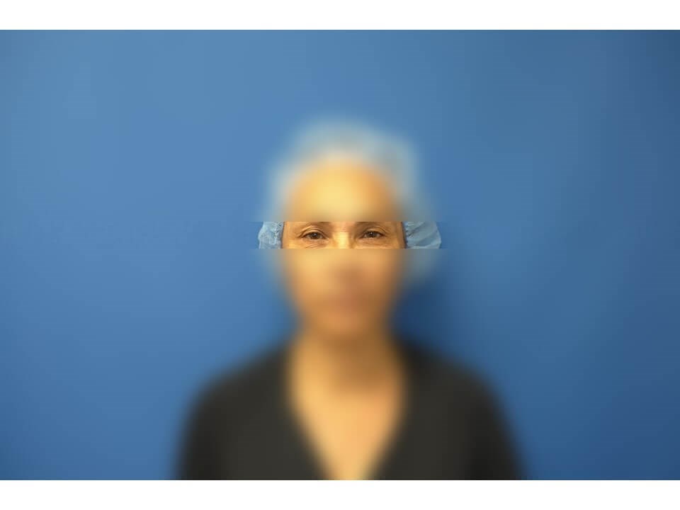 Upper Eyelid Surgery Before