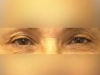 Upper Eyelid Surgery Before