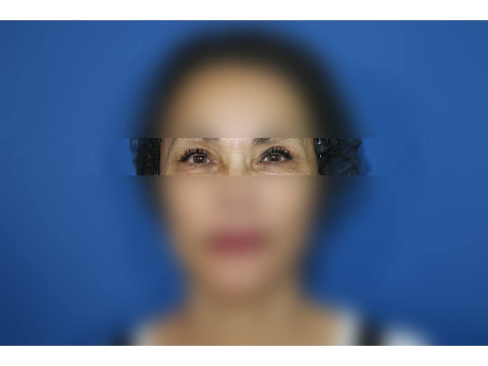 Upper Eyelid Surgery After