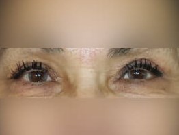 Upper Eyelid Surgery After