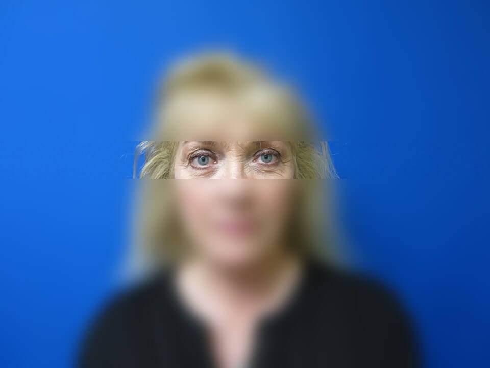 Upper Eyelid Surgery Before