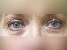 Lower Eyelid Surgery Before