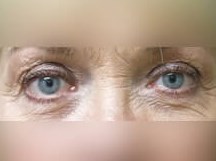 Upper Eyelid Surgery Before