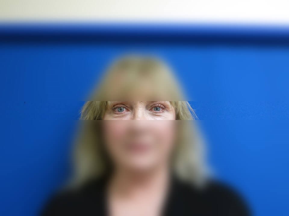 Upper Eyelid Surgery After