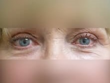 Upper Eyelid Surgery After