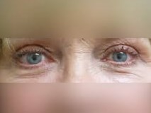 Lower Eyelid Surgery After