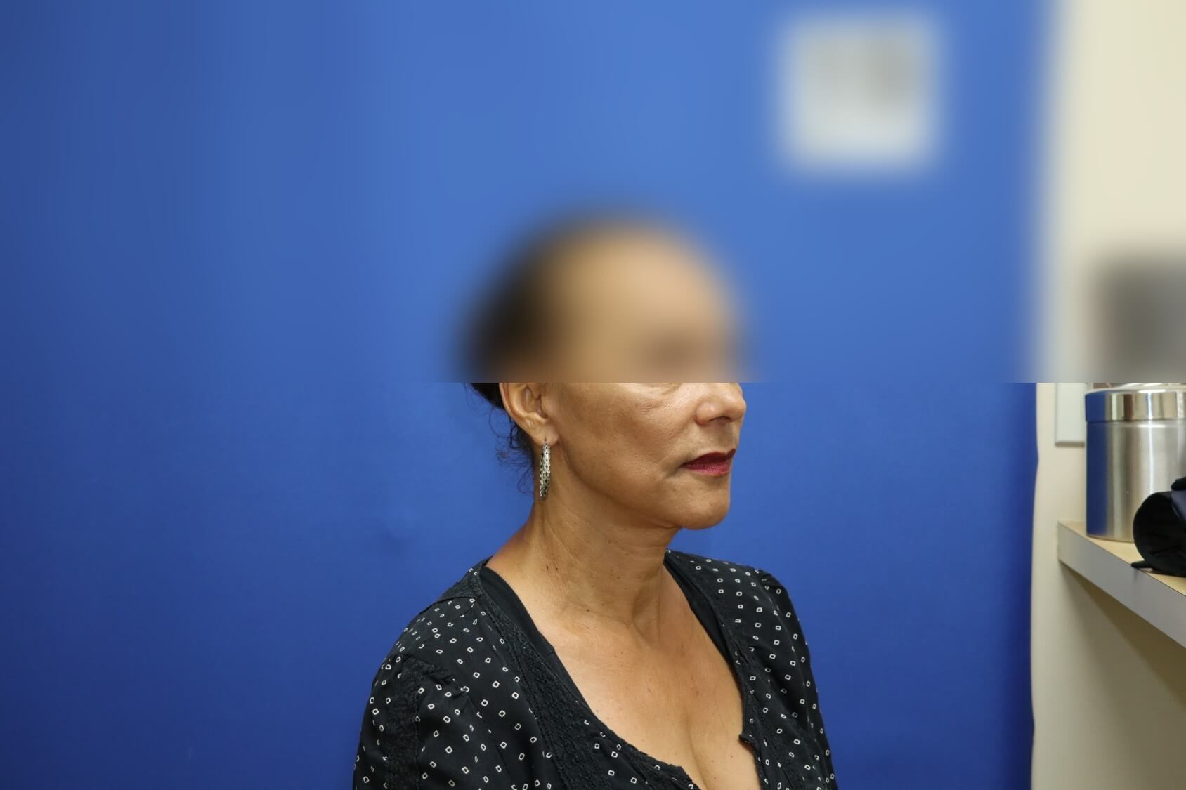Face Lift After