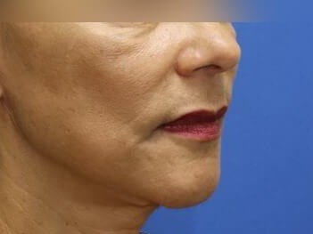 Face Lift After