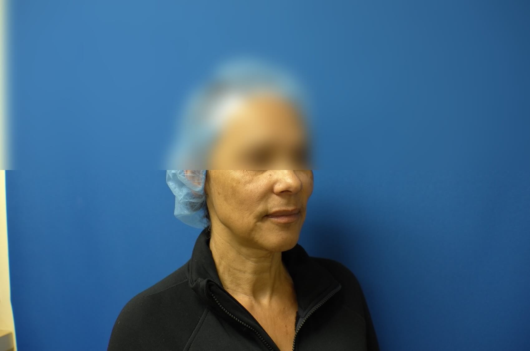Face Lift Before