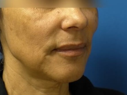 Face Lift Before