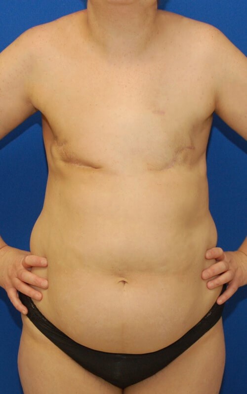 Breast Reconstruction Before