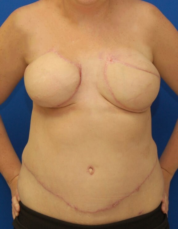 Breast Reconstruction After