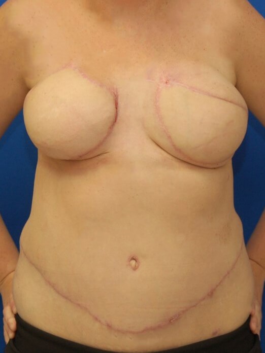 Breast Reconstruction After