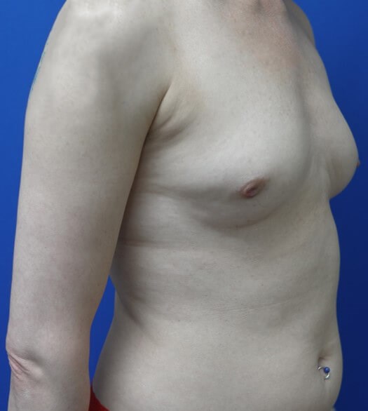 Breast Reconstruction Before