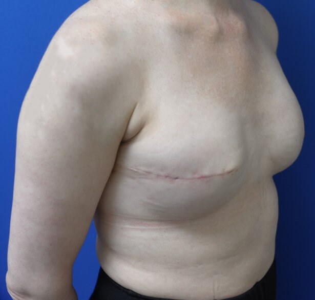 Breast Reconstruction After